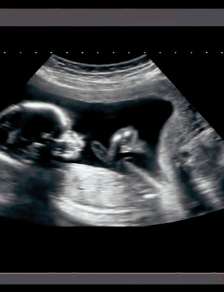 Ultraschallbild eines Fötus im Mutterleib.
